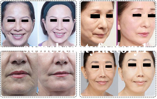 Hot Style 3D Hifu Equipment for Face Lift Wrinkle Removal Skin Tightening