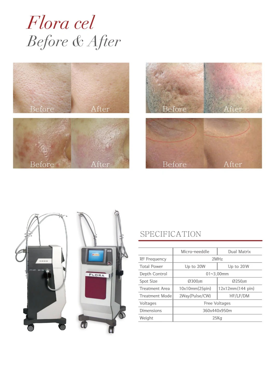 Skin Lifting Fractional RF & Thermal RF Micro Needle Medical Device