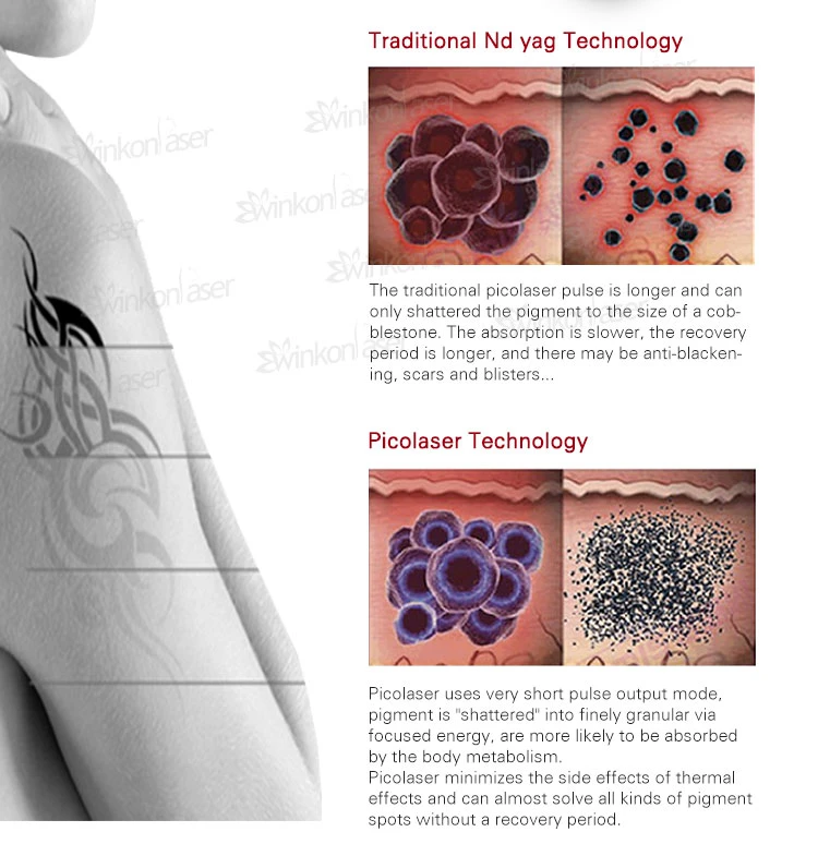 TUV CE TUV Approved High Power Pico Laser Machine Picosecond Laser Tattoo Removal Machine