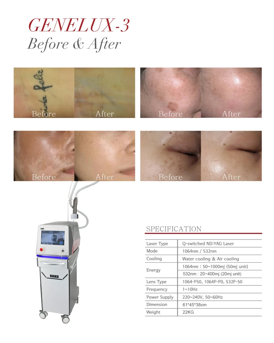Effective Portable Q-Switch ND YAG Tattoo Removal Laser Beauty Device