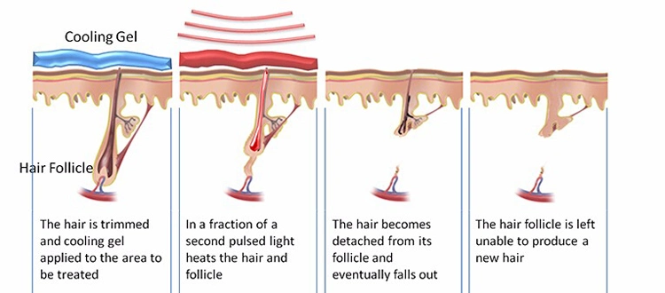 CE FDA Approved 808nm 755 1064 Diode Laser 3 Wavelength Hair Removal Machine Soprano Diode Laser