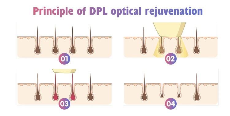 IPL Hair Removal Device Professional Cheap Price Super Wholesale Effective Body/Facial Laser Opt