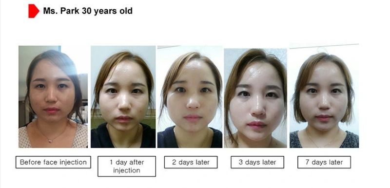 Korean Lipolysis Solution Lipolysis Injection Slimming The Red