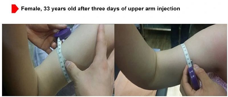Korean Lipolysis Solution Lipolysis Injection Slimming The Red