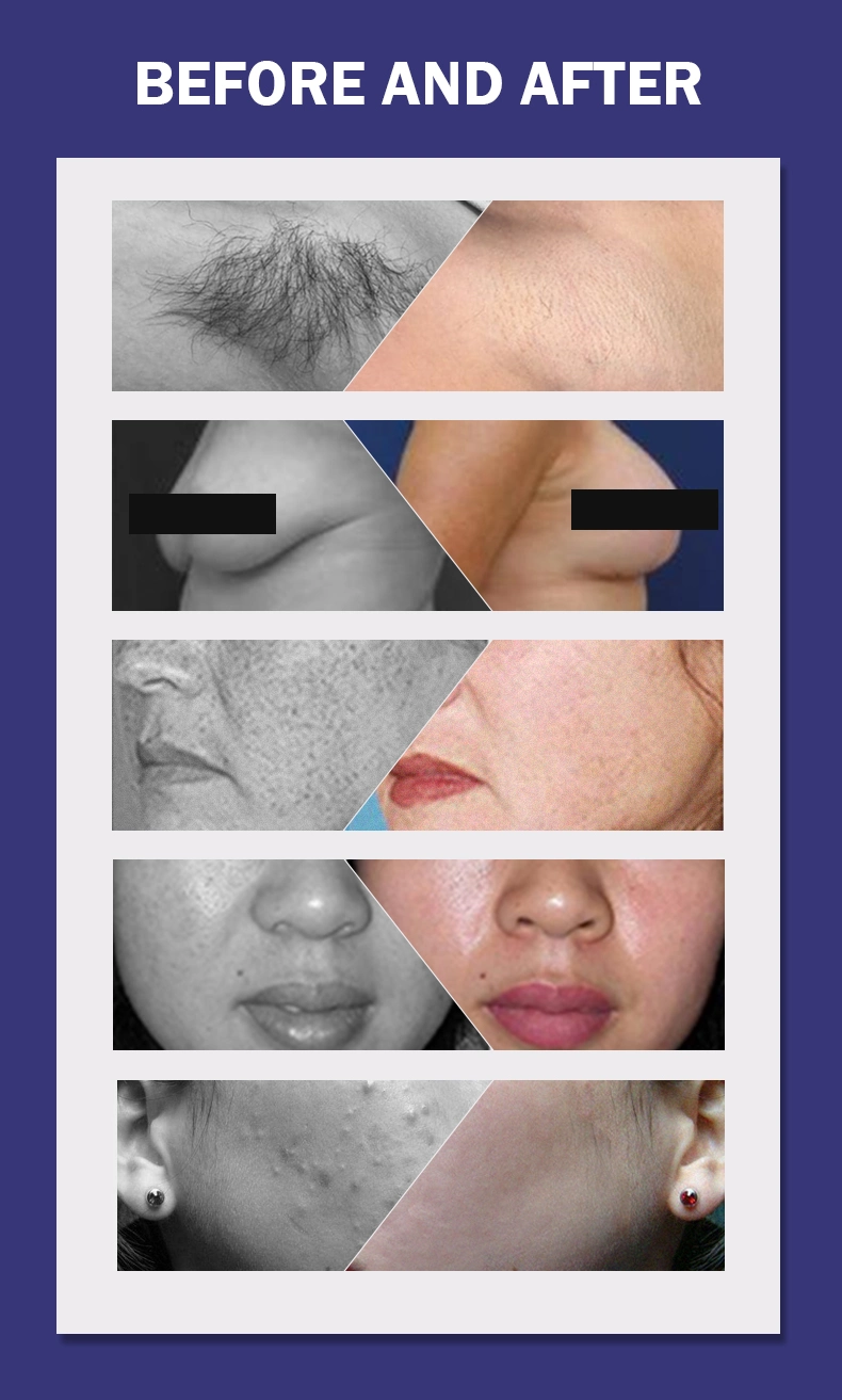 Professional IPL/Shr/Opt Laser Epilator Women Electric Facial Body Hair Remover Skin Rejuvenation Machine