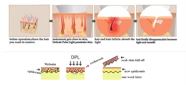 Portable Dpl IPL Elight Opt Shr Fast Permanent Hair Removal Machine