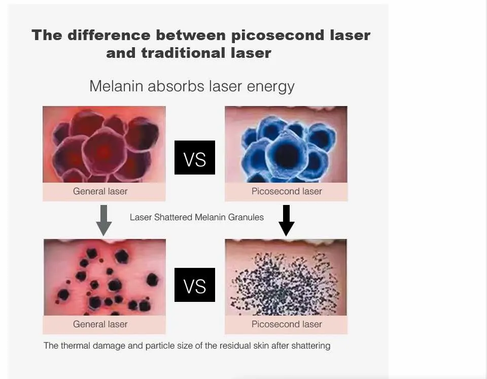 Pico Laser Machine with Four Wavelength to Treat for Tattoo Removal