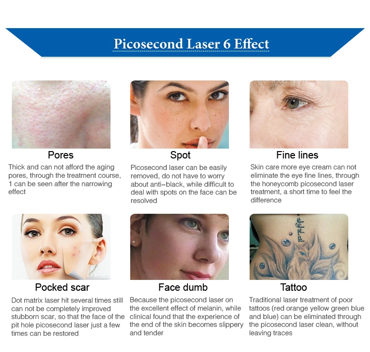 Pico Laser Picosecond Laser Price Laser Tattoo Removal Kit