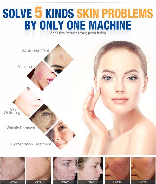Portable Dpl IPL Elight Opt Shr Fast Permanent Hair Removal Machine