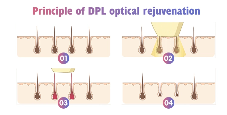 Permanent Hair Remover Cost-Effective Durable Skin Rejuvenation Shr Opt Dpl Laser IPL Machine Lamp