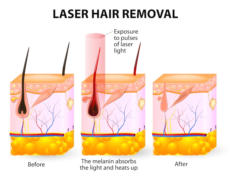 Vertical 808nm Diode Laser Machine Hair Removal Depilator Laser Beauty Machine