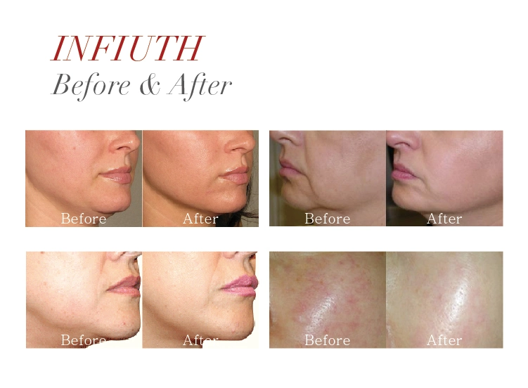 High Intensity Focused Ultrasound Antiaging Hifu Salon Equipment