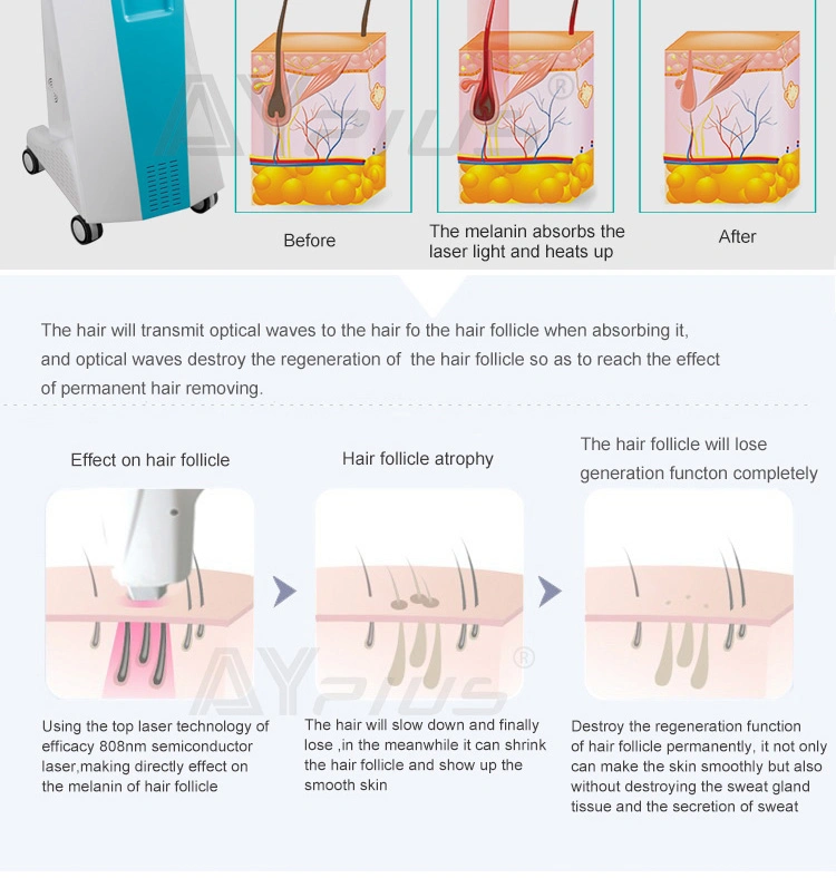 808nm Diode Laser Hair Removal Shr Sapphire Hair Removal Laser