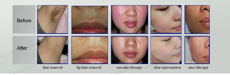 Hair Removal IPL / IPL Hair Removal Machine/Elight IPL