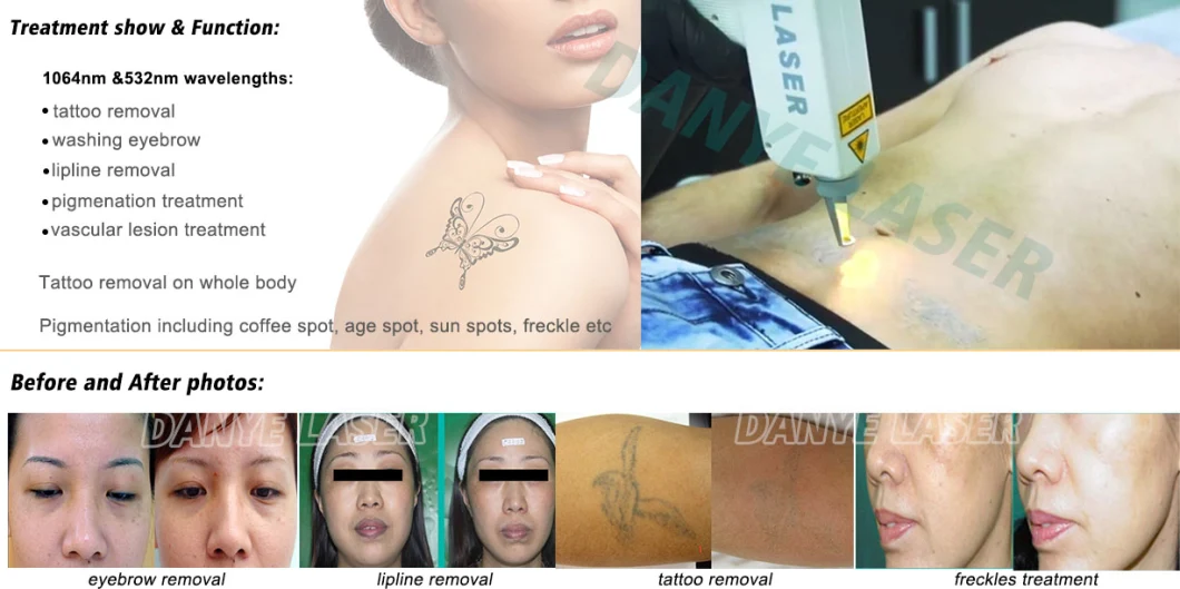Cheap Handheld 1064-Nm ND YAG Laser Tattoo Removal Laser Machine Price in India