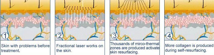 Lser CO2 Fraccionado Skin Resurfacing Scar Removal Laser Medical Machine