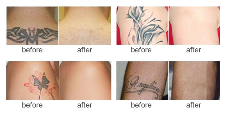 Effective Salon SPA Laser Tattoo Birthmark Removal Q Switch ND YAG Device