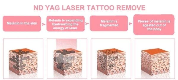 Multifunction IPL Shr Elight Opt RF ND YAG Laser Hair Removal Tattoo Removal Skin Rejuvenation Machine