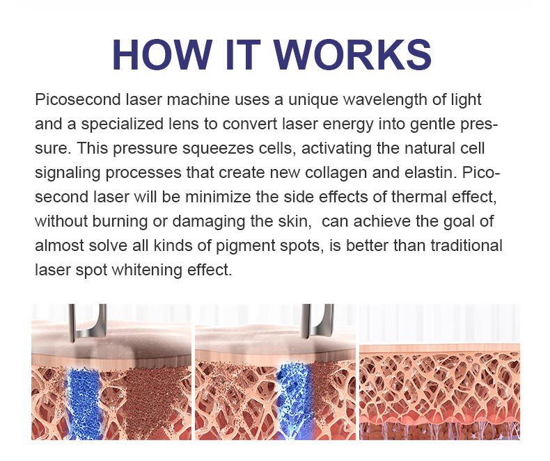 Pico /Picosecond Laser/ Tattoo Removal Laser Picoway Machine for Salon