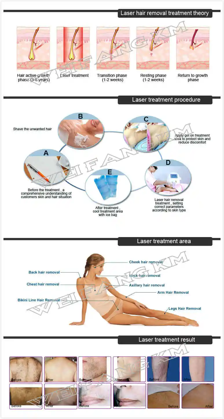Italy Portugal Hot Fotoepilazione Laser Alexandrite Laser Hair Removal 810nm 808 Diode a Laser