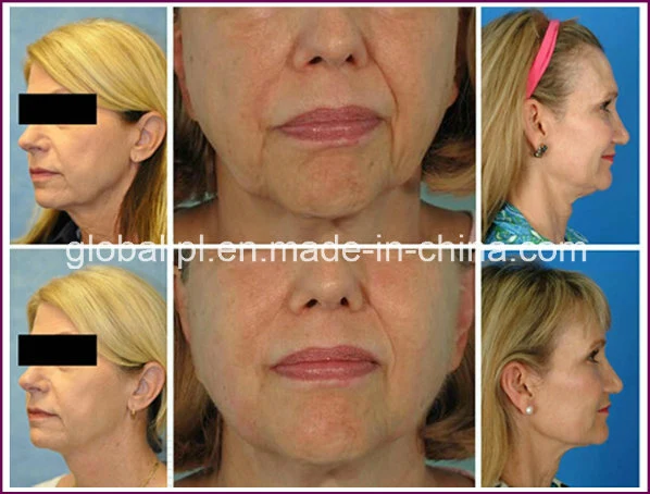 High Intensity Focused Ultrasound Facial Lifting Hifu Globalipl Equipment
