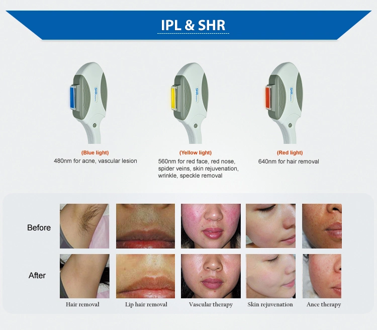 Opt/IPL Shr Machine for Rapid Permanent Hair Removal