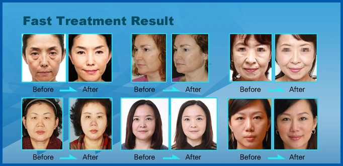 Wholesale Factory Price Face RF Thermal Face Lifting Skin Tightening Beauty Machine