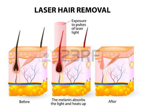 Beauty Salon Equipment IPL Hair Removal Laser Equipment