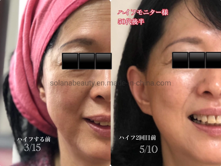 Portable Painless Vmax Hifu Ultrasonic Hifu Wrinkle Removal Anti-Aging Beauty Equipment
