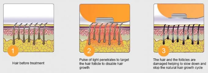 IPL Permanent Laser Hair Removal Shr Laser Machine E-Light IPL RF