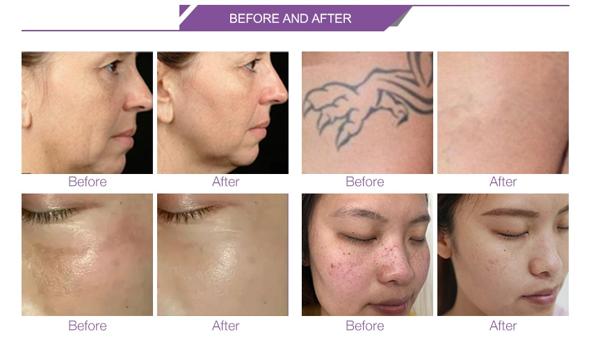 Sunbum Age Spot Chloasma Skin Remove ND YAG Laser Device