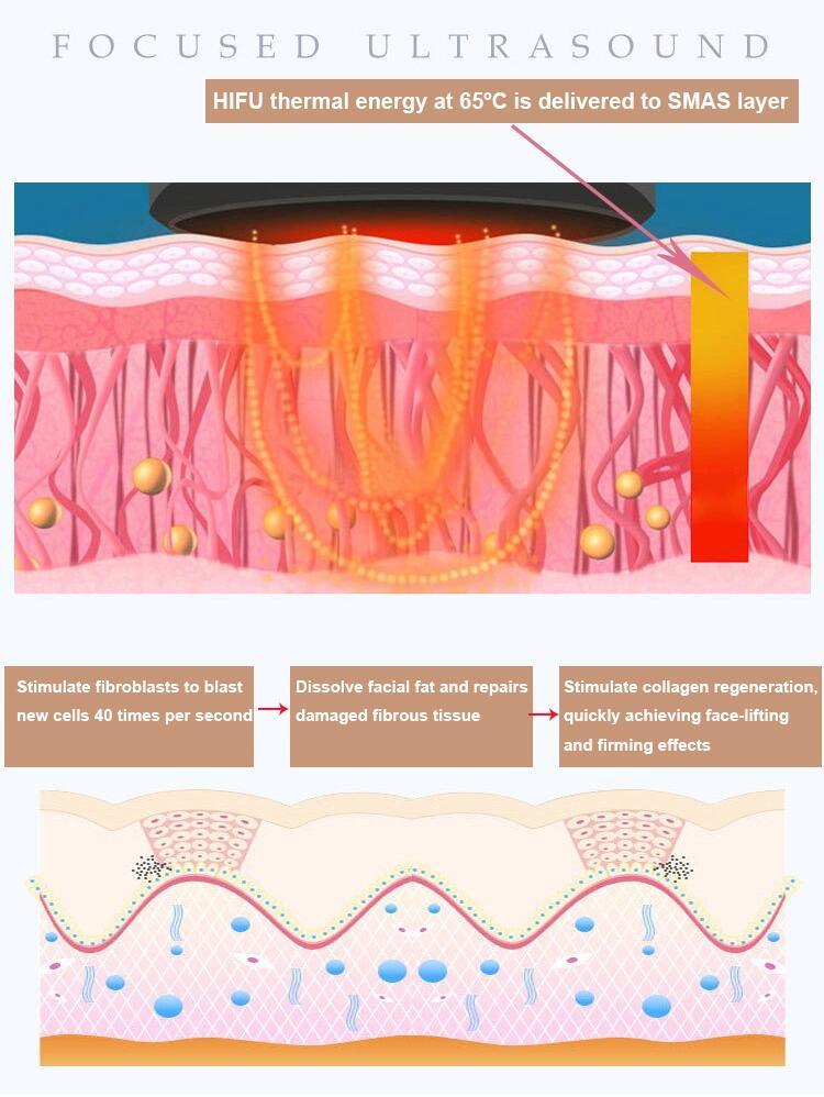 Face Lift Wrinkle Removal V-Max Hifu Ultrasound Therapy Machine