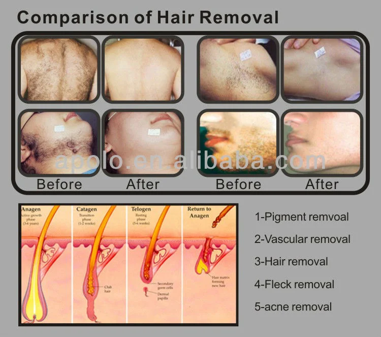 IPL Skin Rejuvenation and Hair Removal IPL Shr Device (HS-300C)