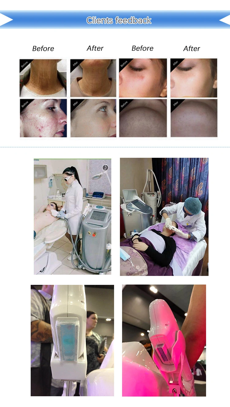 Beijing Sincoheren Two Handle Pieces IPL Shr RF Hair Removal Machine with Good Price