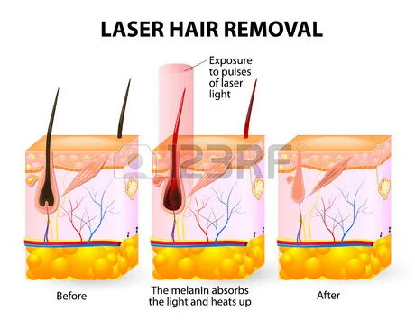 Forever Hair Removal Diode Laser for 808nm/1064nm Diode Laser Beauty Machine