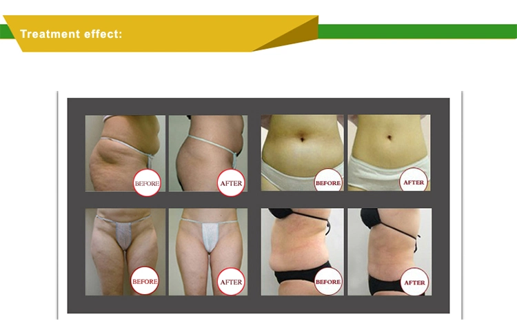 Best Selling Velashape Slimming Machine for Body Slimming Machine