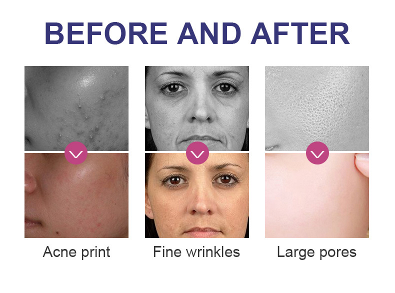 Most Effective Skin Rejuvenation RF Blackhead Remover Oxygen Therapy Machine Jet Peel Facial