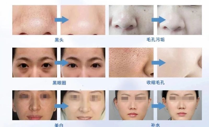 Microdermabrasion Hydrafacial Machine Skin Peeling Skin Scanner Analyzer