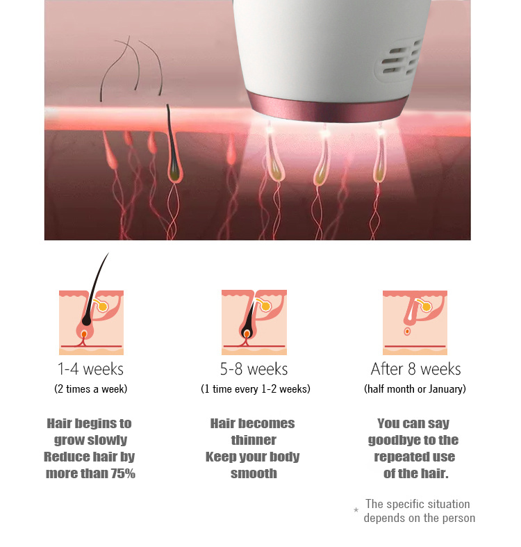 808nm Diode Laser Hair Removal 808 Machine with Good After Sale Service