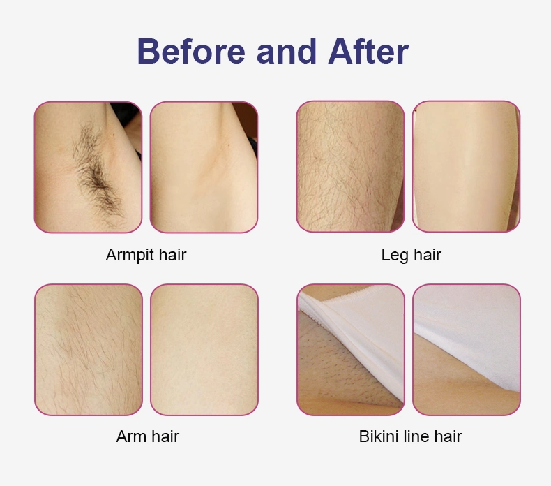 Permanent Hair Removal for Women 808 Diode Laser Machine for Hair Removal