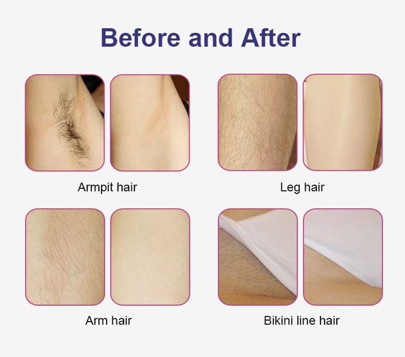 Newest Hot Sale Diode Laser 808 Remove Unwanted Hair Permanently