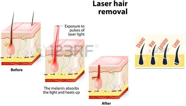 Fast Hair Removal 808nm Diode Laser Beauty Medical Equipment