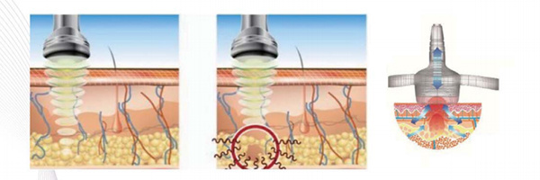 OEM Cavitation Slimming Ultrasonic + RF Machine (US307)