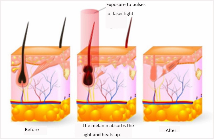 Vertical IPL Shr&IPL Fast Hair Removal Equipment