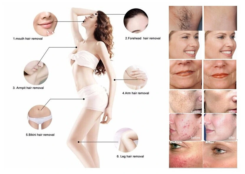 Laser Beauty Machine Hair Removal IPL Laser Spider Vein Removal