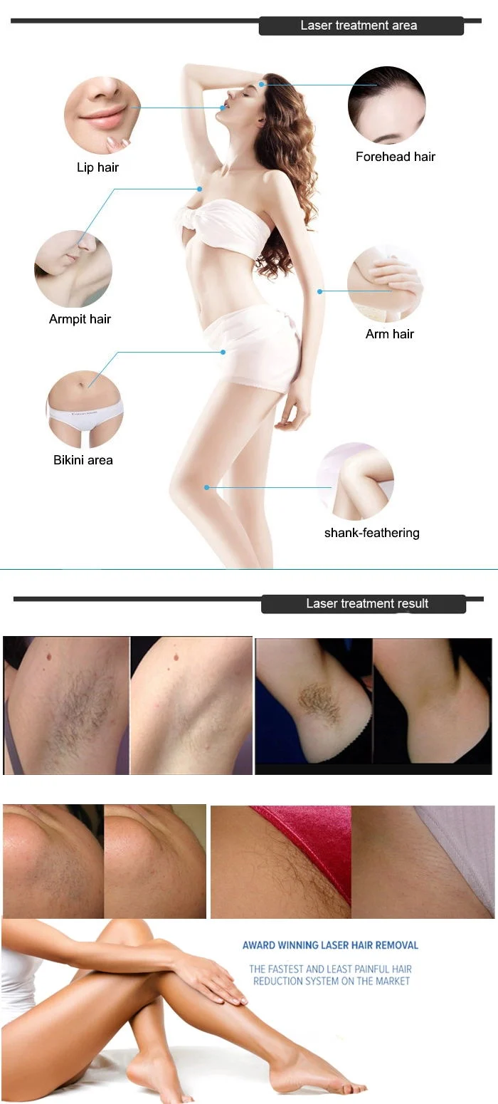 50% Discount 808 Epilator Laser Hair Removal Machine/ 808nm Diode Laser/ Laser Diodo Hair Removal