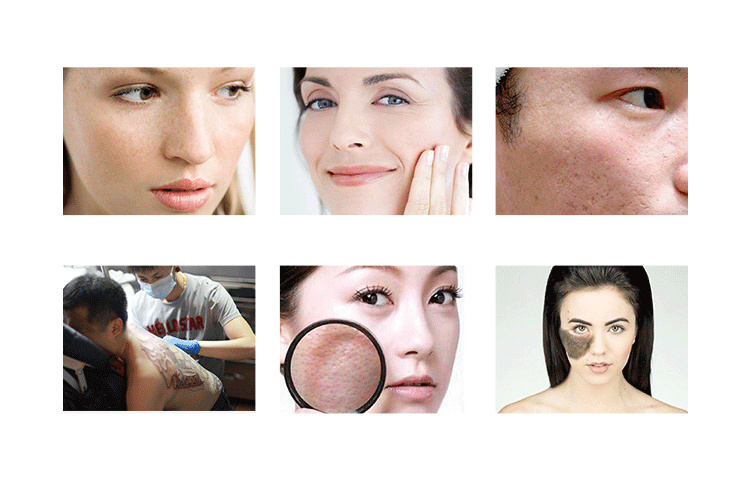 Hot Sale Beauty Machine Picosecond ND YAG Laser Tattoo Removal Skin Whitening Removel Picolaser Machine
