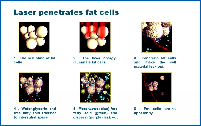 3 in 1 Diode Laser+Cavitation+RF Slimming Machine