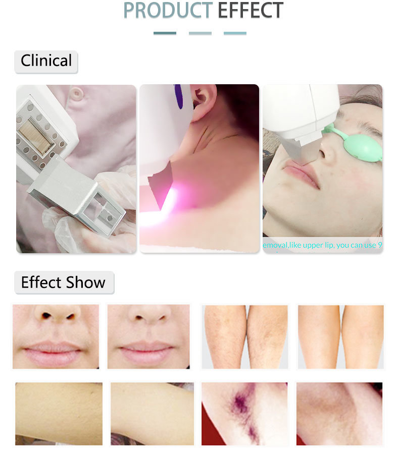 Expert Professional 1064 755 808 Laser Hair Removal Beauty Equipment