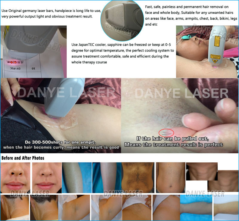 Best Selling Diode Triple Laser 808nm for Hair Removal